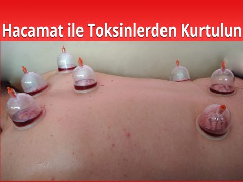 hacamat ile toksin temizliği
